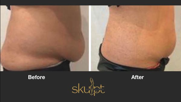 stomach before and after